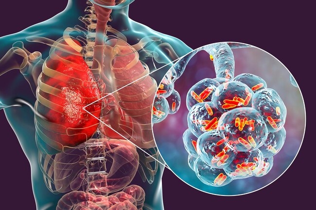 Legionnaire's Disease Lawsuit